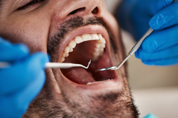 Best Emergency Wisdom Teeth Removal in Poplar Cotton Center, CA
