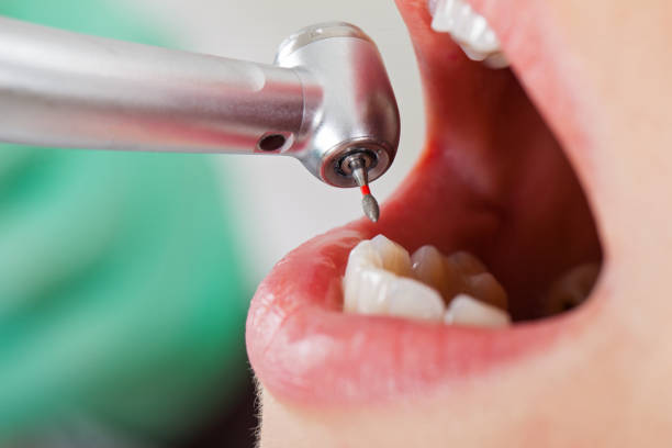 Best Emergency Tooth Extraction in Poplar Cotton Center, CA